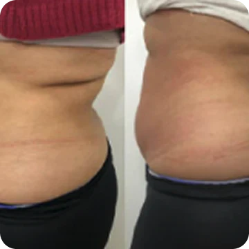 Belly Bloating That Has Nothing to Do With Food